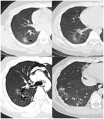Case report: A suspected case of chronic pulmonary sparganosis characterized by migrating cavities and tunnel sign
